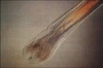 Il bulbo pilifero rimane chiaro in un tubo test, in assenza dell'enzima tirosinasi. La diagnosi &egrave; OCA ty-neg