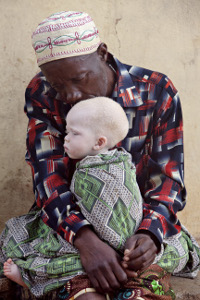 foto di un uomo africano che bacia un bimbo albino