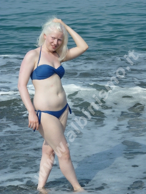 Estate:albinismo, pelle chiara e sole