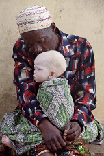 Albinismo africa: padre nero e figlio bianco