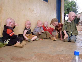 bimbi africani albini